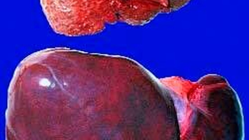 Feinknotige Zirrhose bei Alkoholabusus zum Vergleich mit einer Normalleber