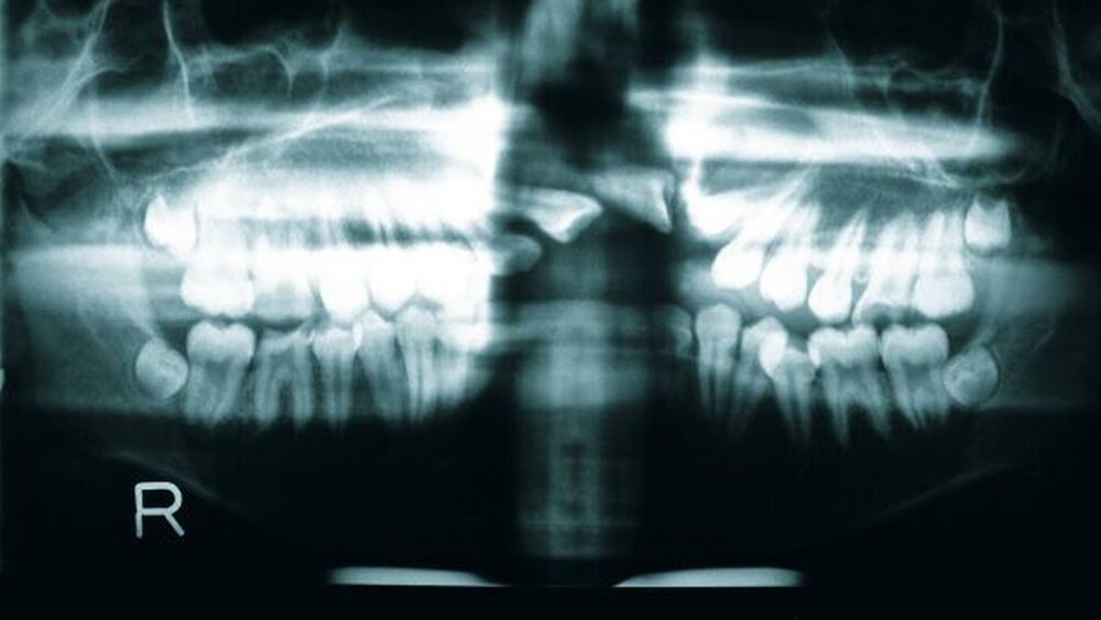 Abbildung 3: Das analoge OPTG gibt einen ersten Einblick über das Ausmaß der knöchernen Fehlbildung. Es bestehen Kippungen der Frontzähne. Der Zahn 22 ist angelegt, aber nicht durchgebrochen. |