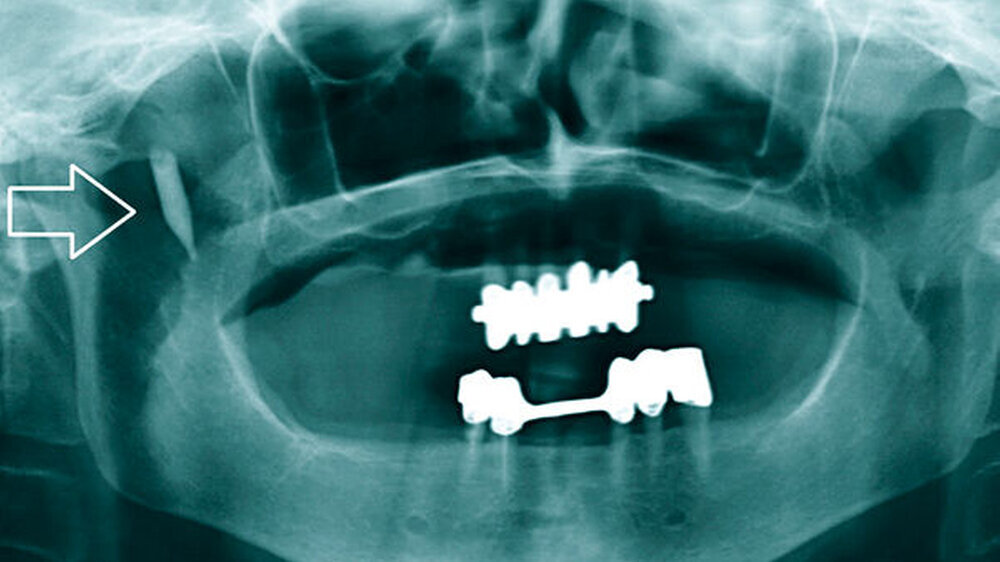Abb. 1: Panoramaschichtaufnahme der Patientin am Tag der Erstvorstellung: Im Bereich des rechtsseitigen Processus coronoideus des Unterkiefers ist ein röntgendichtes Objekt zu identifizieren (Pfeil).\r\n\r\n