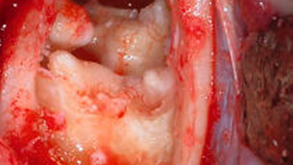 Intraoperative Darstellung der Raumforderung |