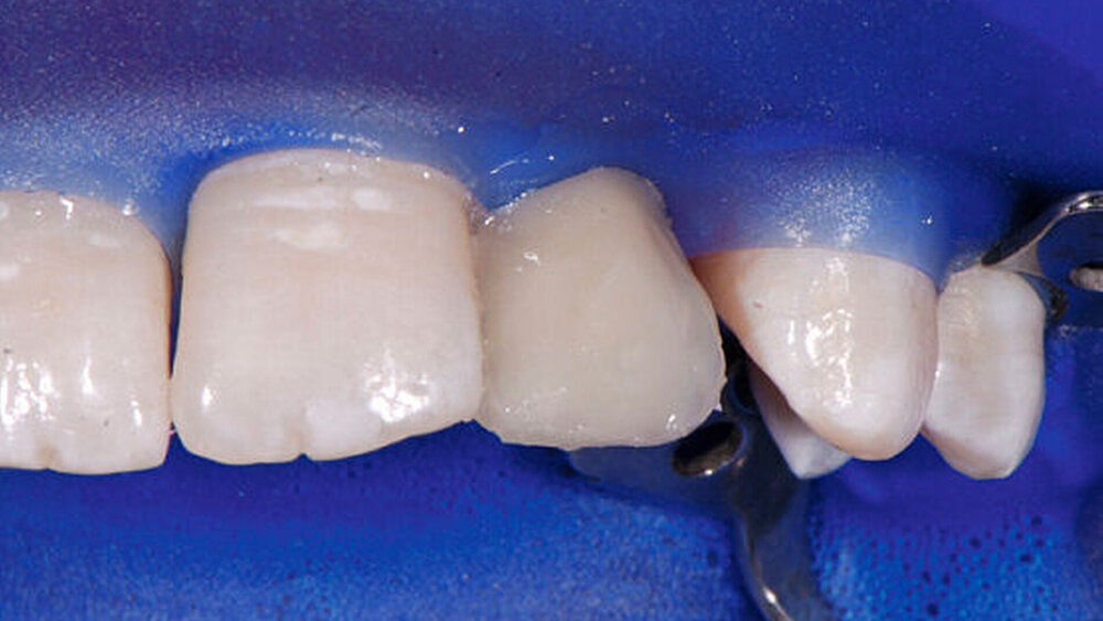 Dentinkern-Aufbau mit CeramX duo D1/D2 |