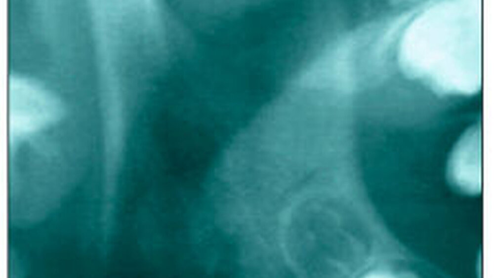 Abbildung 3a: Gesundes Gelenk mit konvexem Kondylus |