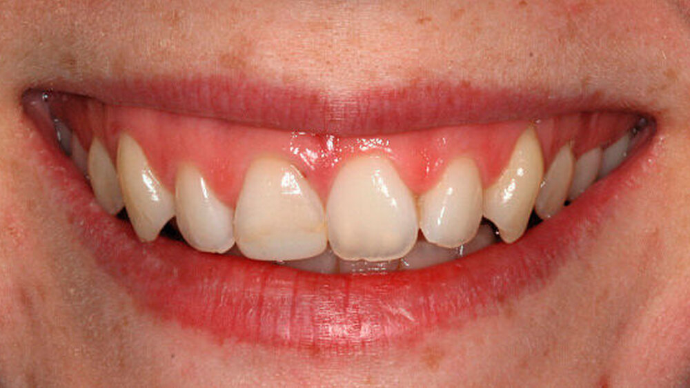 Abbildung 1: Zahn 11 muss wegen in- und externer Wurzelresorption (klinisch durch Pus und radiologisch durch Einzelzahnaufnahme bestätigt) post Trauma extrahiert werden; Ausgangssituation an Zahn 11 in situ: hohe Lachlinie, „gummy smile“, dreieckig g