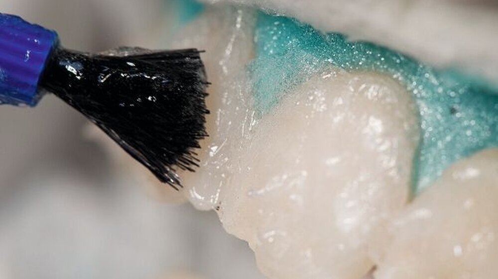Die Änderung der EU-Kosmetikrichtlinie greift auch das Thema Bleaching auf. Beim Umgang mit Zahnbleichmitteln gibt es nun Klarheit für Zahnarzt und Patient. | Die Änderung der EU-Kosmetikrichtlinie greift auch das Thema Bleaching auf. Beim Umgang mit Zahnbleichmitteln gibt es nun Klarheit für Zahnarzt und Patient. |