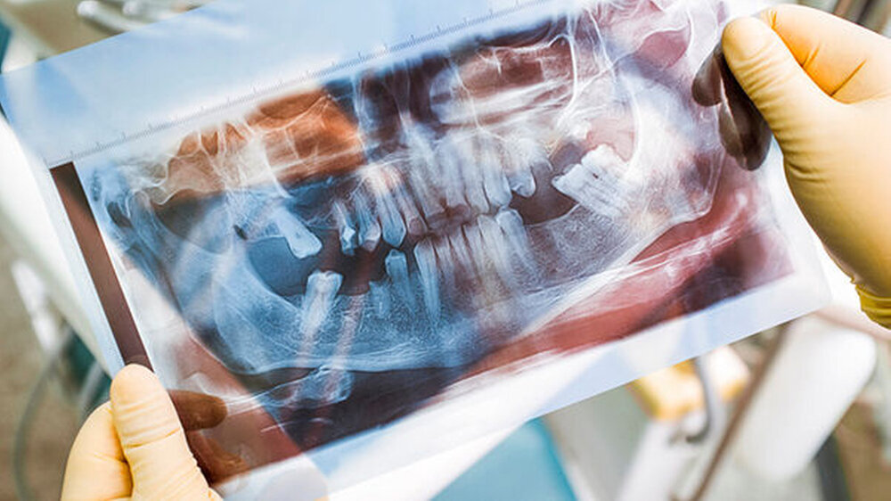 Das Bayerische Landessozialgericht hat entschieden, dass die gesetzlichen Krankenkassen zahnmedizinische Leistungsfälle nur durch den MDK begutachten lassen dürfen.