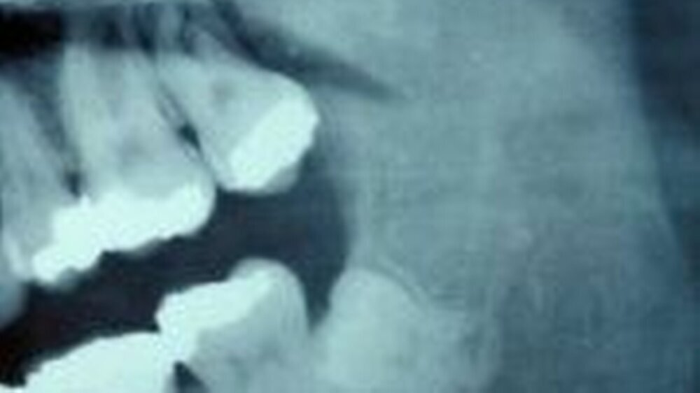 Abbildung 1: Der Ausschnitt des Orthopantomogramms (OPG) zeigt eine Osteolyse apikal und distal des Zahnes 27. Der Zahn 28 ist retiniert und nach cranial verlagert.
