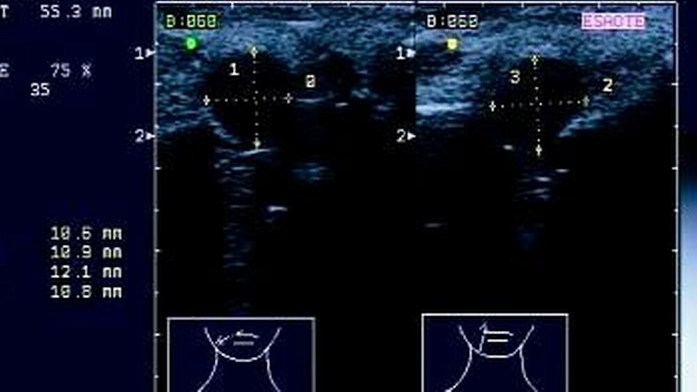 Abbildung 1: Sonographische Darstellung: Die Zyste imponiert als kreisrunde, echofreie Läsion mit einer deutlichen dorsalen Schallverstärkung. Sonographisch wird auch die Einsenkung des Befundes in die Kontur des Oberkiefers erkennbar.