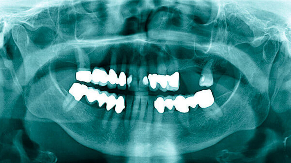 Abbildung 3: Panoramaschichtaufnahme der Patientin |