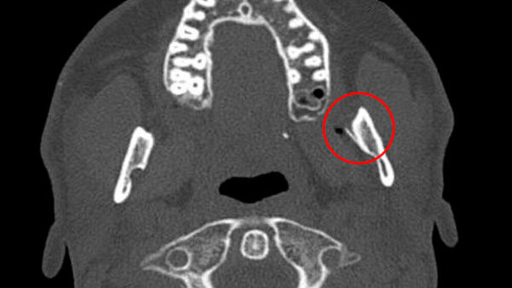 Hier zeigte sich als Corpus alienum die frakturierte Kanüle in unveränderter Position im Bereich der medialen Seite des aufsteigenden Unterkieferastes auf Höhe des Foramen mandibulae zwischen Unterkieferknochen und Musculus pterygoideus medialis