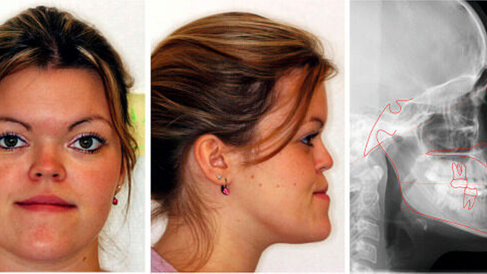 Abbildung 1: a) Extraoraler Befund der Patientin von frontal und lateral: Die Analyse ergab ein verkürztes mittleres Gesichtsdrittel, ein nach vorne schiefes Vorgesicht, einen spitzen Nasolabialwinkel und eine positive Lippentreppe. Das Fernröntgenseitenbild zeigt den skelettalen Befund.  |