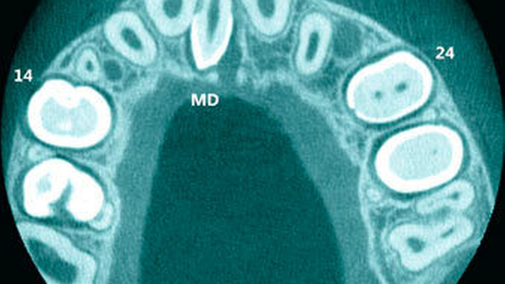 3e: Horizontalschnitt mit Darstellung des Mesiodens (MD). |