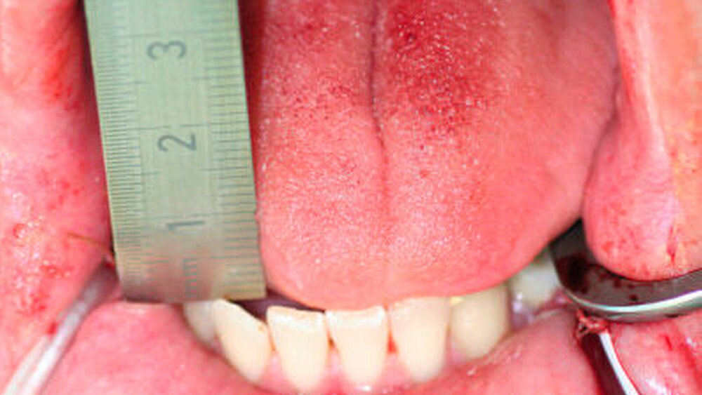 Abbildung 5: Intraoperative Munddehnung nach beidseitiger Coronoidektomie auf SKD 39 mm |