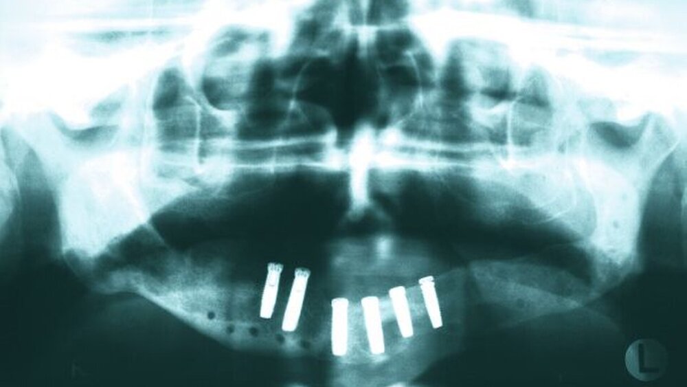 Abbildung 19: OPG im Recall zwei Jahre nach Eingliederung: Die Implantate zeigen eine gute Osseointegration und nur minimalen Knochenabbau Regio 31/41. |