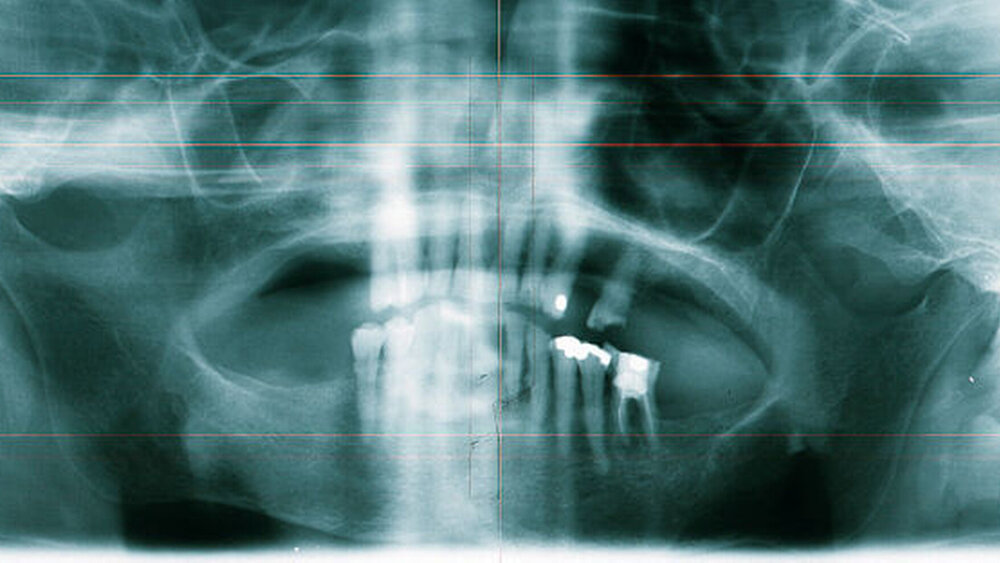 Abbildung 2: Alio loco angefertigte analoge Panoramaschichtaufnahme mit einem Knochendefekt in regio 027 bei ansonsten parodontal geschädigtem Restgebiss und apikaler Aufhellung an Zahn 36 |