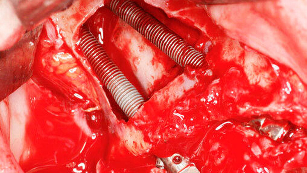 Abbildung 4 b) Intraoperative Situation nach Insertion von zwei Zygoma-Implantaten. Die laterale Kieferhöhlenwand wurde im Rahmen eines externen Sinuslifts hierbei zur palatinalen Kieferhöhlenwand verlagert. Die Implantate stehen vestibulär dieses Knochendeckels. |