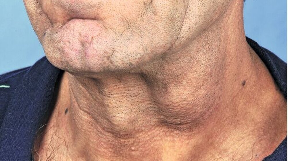 Abbildung 1: Klinischer Aspekt der Halsraumforderung: Der Befund ist als prallelastische Raumforderung am Vorderrand des Musculus sternocleidomastoideus palpabel.