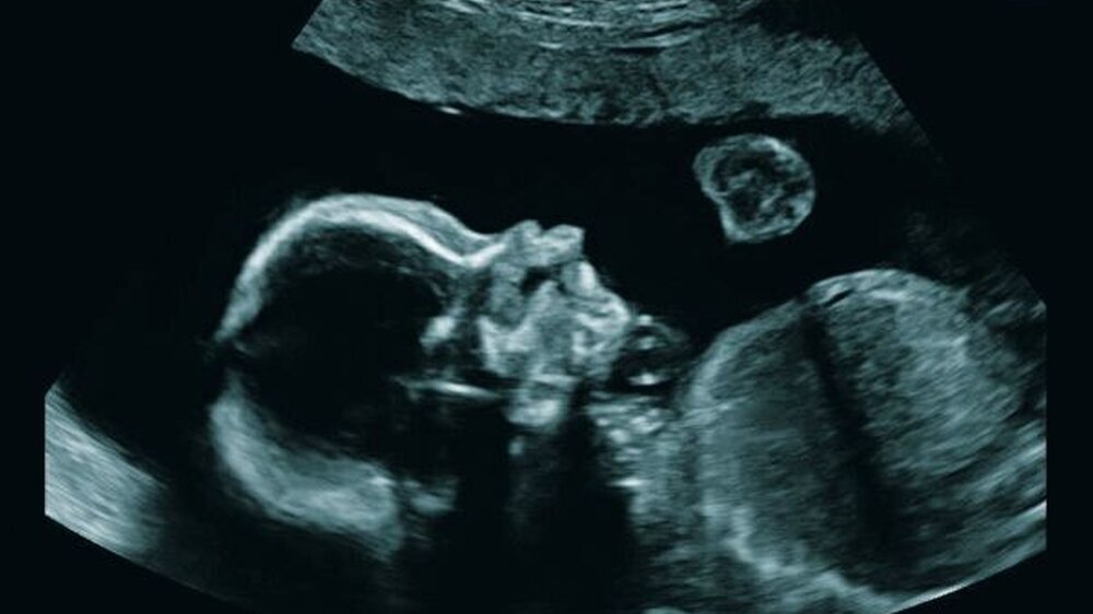 Ultraschallaufnahme im Rahmen der Vorsorgeuntersuchung in der 23. Schwangerschaftswoche