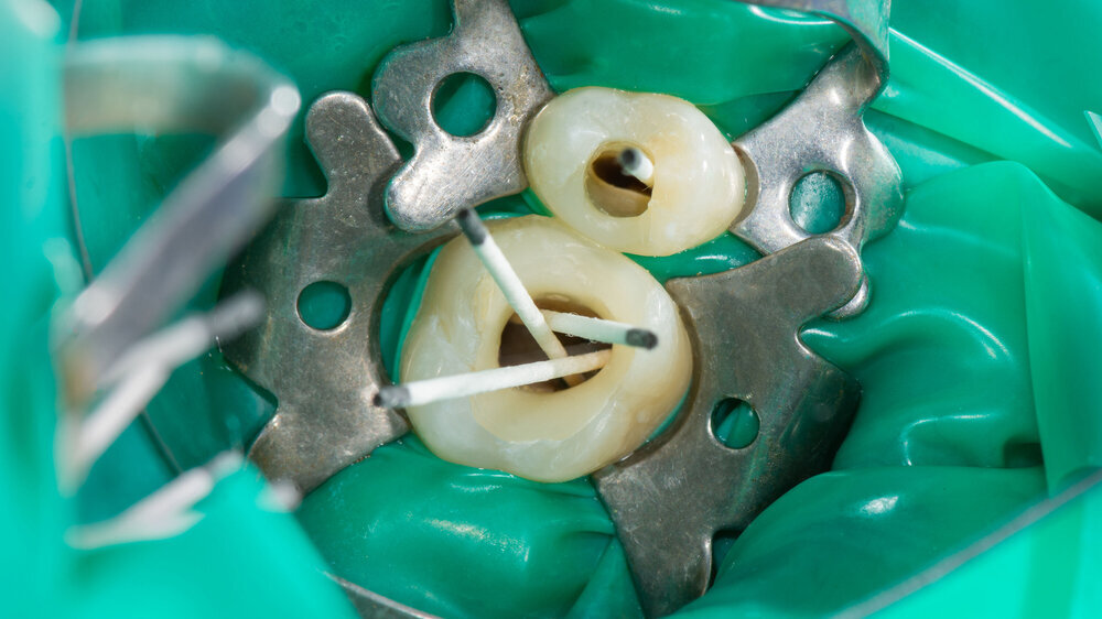 Zähne haben nach einer endodontischen Behandlung eine durchschnittliche Überlebenszeit von elf Jahren, wobei diese von der postendodontischen Versorgung der Zahnkrone abhängt.