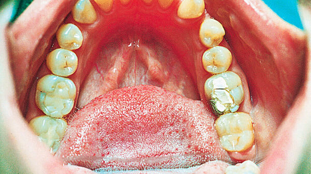 Abbildung 1: 36 mit provisorischer Versorgung nach notfallmäßiger endodontischer Behandlung Abbildung 1: 36 mit provisorischer Versorgung nach notfallmäßiger endodontischer Behandlung