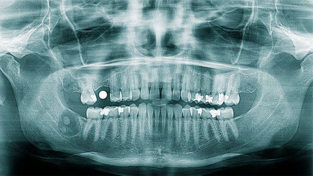 Abbildung 1 und 2: Präoperativer Befund im Orthopantomogramm mit Darstellung der Läsion in repräsentativer axialer Schicht. Erkennbar sind die mineralisierten Anteile sowie eine Auflösung der lingualen Lamelle. |