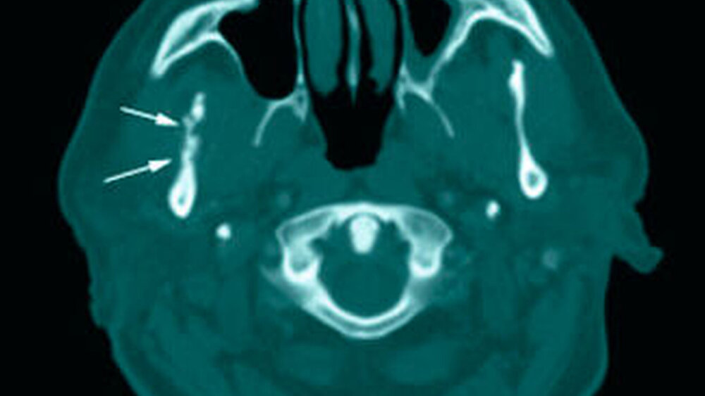 Abbildungen 2a bis 2c: Axiale Schichten aus der Computertomografie nach Abszessspaltung, im Weichteilfenster (a) mit noch nachweisbarem Verhalt im Bereich des Processus muscularis (Pfeile), im Bereich des aufsteigenden Unterkiefer-Astes (b) und im Unterkieferkorpus (c), beide im Knochenfenster: Deutlich zu erkennen sind die alterierte Knochenstruktur mit sklerotischen Veränderungen (besonders in c) und größere Osteolysen (b).(Nebenbefundlich eine Schleimhautschwellung in der linken Kieferhöhle) |