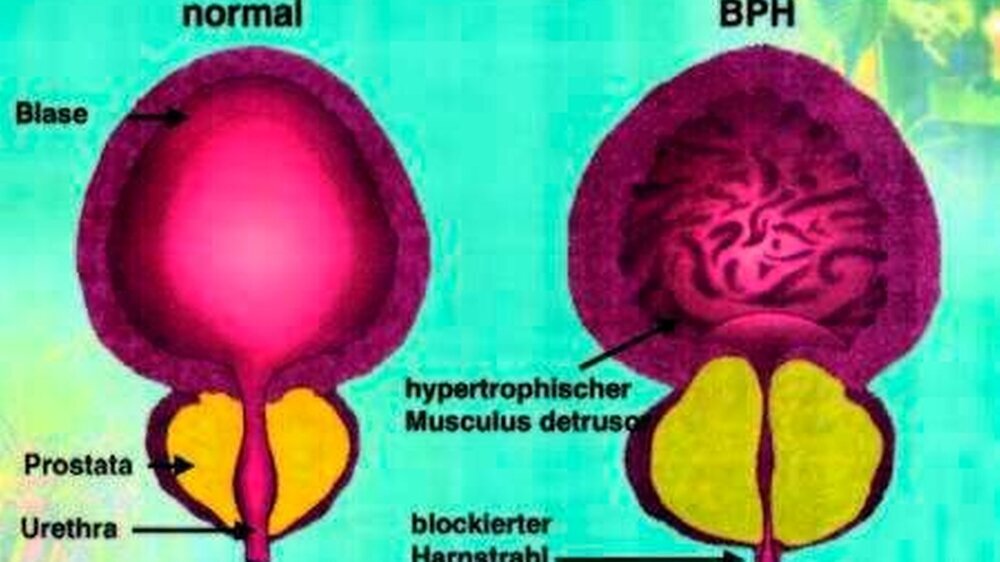 Pathologische Anatomie der BPS