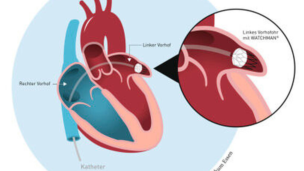 Schematische Darstellung eines Vorhofimplantats |