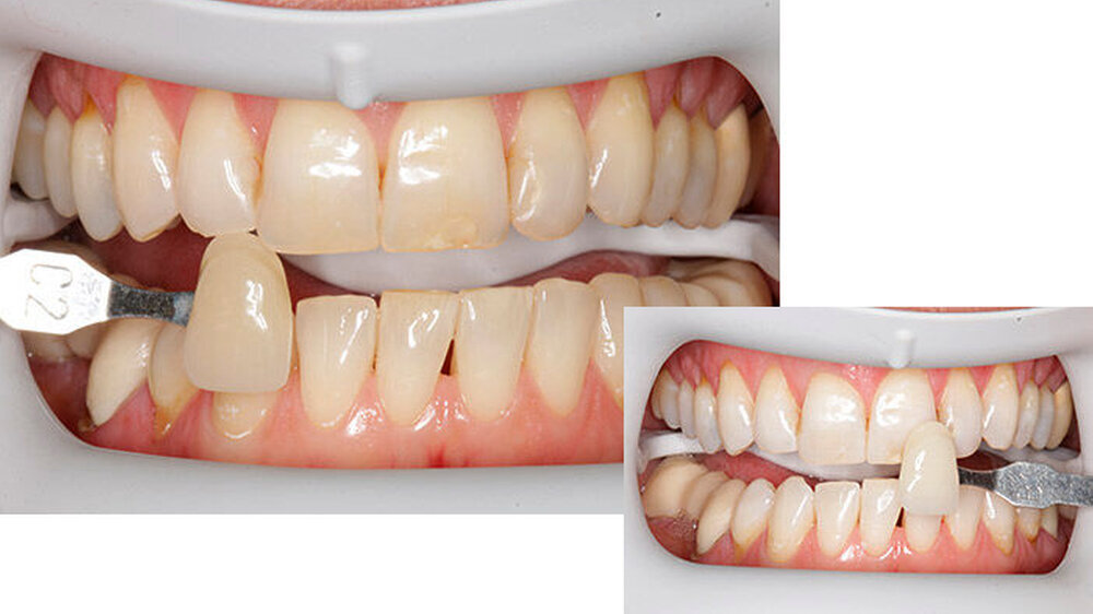 Vor dem Bleaching hatte der Patient die Zahnfarbe C2, ...