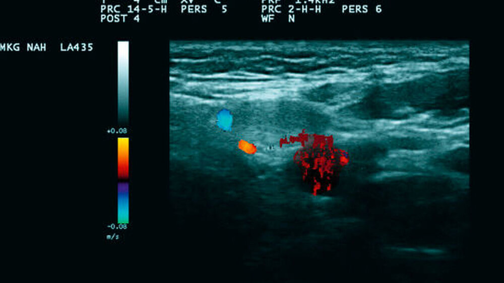 Abbildungen 2a und 2b: Ultraschall der Halsweichgewebe mit zum Teil deutlich vergrößerten Lymphknoten (a) in unmittelbarer Nachbarschaft zu den Gefäßen (b) markiert als oranges und blaues Areal |