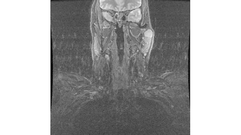 148642-flexible-1900 Abbildung 1a: MRT Kopf-Hals: koronare T1-gewichtete Aufnahme mit homogener Signalanhebung im linken oberflächlichen Parotislappen |