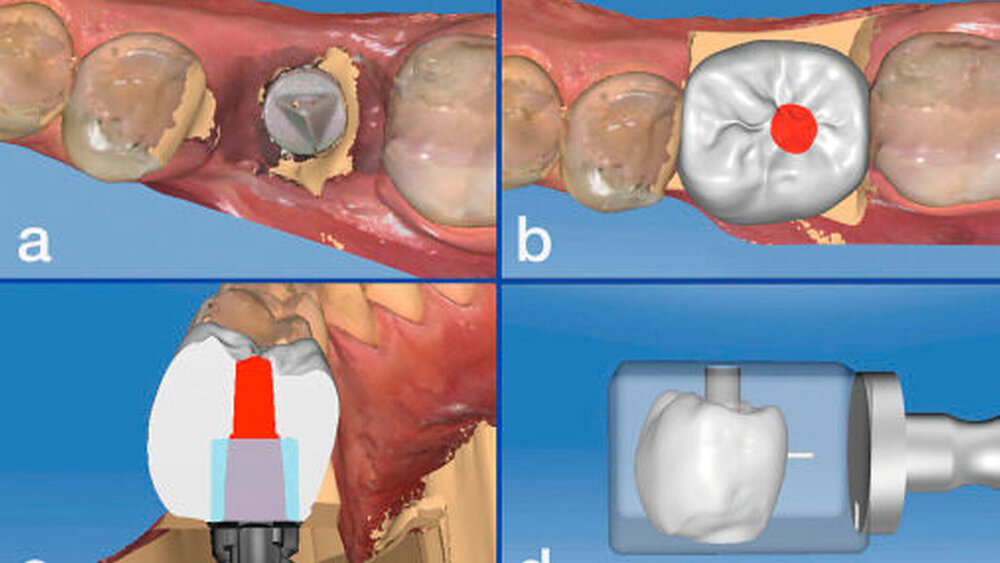 Abbildung 5: Herstellung einer Chairside-CAD/CAM-Implantatkrone. Mithilfe des Cerec-Systems wurde die Implantatposition über einen Scan-Body (a) digital abgeformt (Cerec Omnicam) und eine vollanatomische okklusal verschraubte Implantatkrone mit einer Software designt (b). Die Position des Schraubenkanals und der Titanbase (c) kann mit dem CAD/CAM-System überprüft werden. Die vollanatomische Implantatkrone kann dann in einer Schleifeinheit chairside aus Lithiumdisilikatkeramik IPS e.max CAD (d) hergestellt werden. |