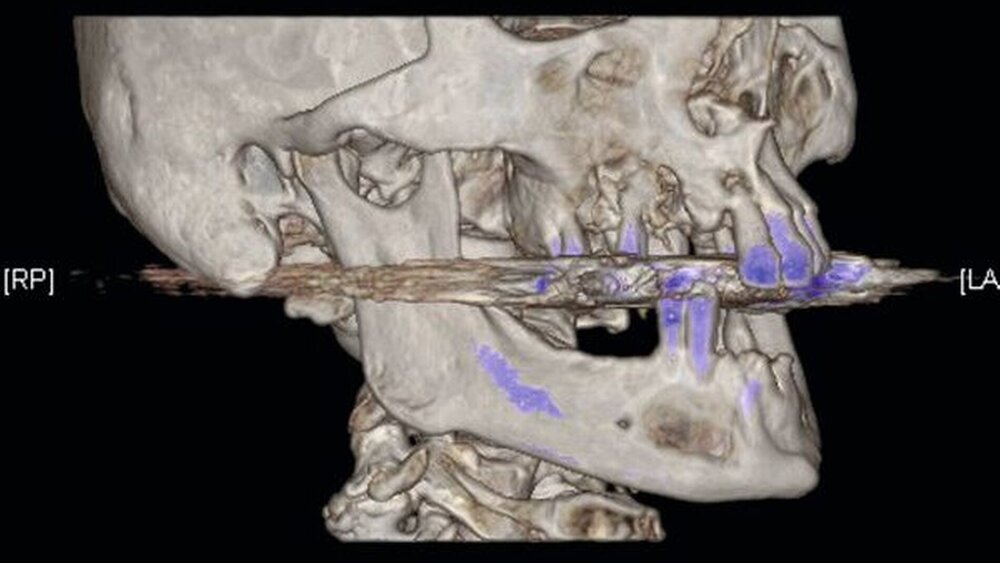Abbildung 2: In der 3-D-Rekonstruktion des CT-Datensatzes zeigen sich die Destruktion der fazialen Kieferhöhlenwand rechts und die zystische Ausdehnung im UK. |