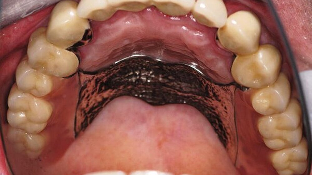 Abbildungen 16a, 16b, 16c, 16d, 16e: Abschlussbefund (definitiv befestigte Kronen und Brücken sowie eingegliederte partielle obere Prothese). |