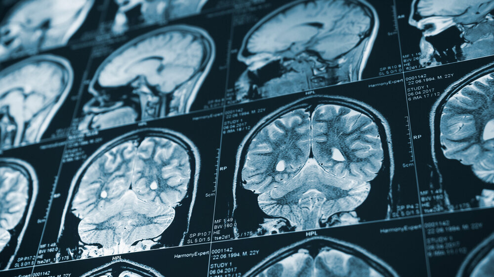 Close up series of a CT scan with human head on it. X-ray medicine concept CT
