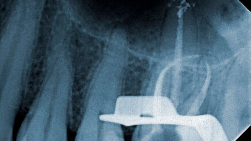 Abbildung 4: Röntgenologische Kontrollaufnahme nach thermoplastischer Wurzelfüllung |