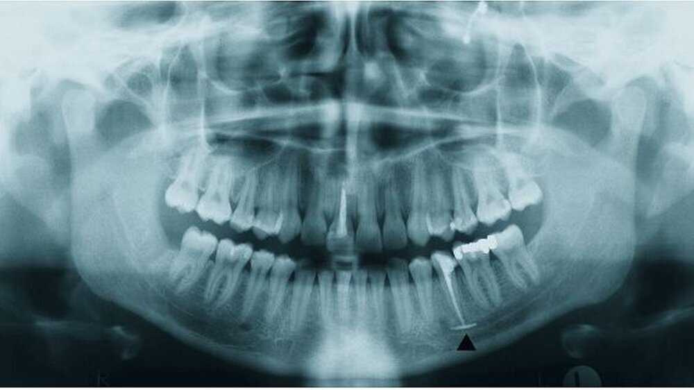 Abbildung 1: Orthopantogramm mit deutlicher Opazität im Verlauf des Canalis mandi - bularis unterhalb des endodontisch therapierten Zahnes 35.