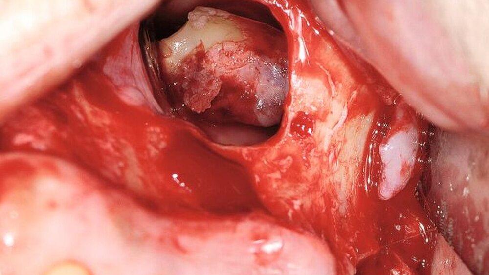 Abbildung 4: Intraoperativer Situs nach Knochenfensterung mit Darstellung des Wurzelrests 27 im Sinus Maxillaris, paramarginale Schnittführung vom Caninus zur Extraktionsalveole. |