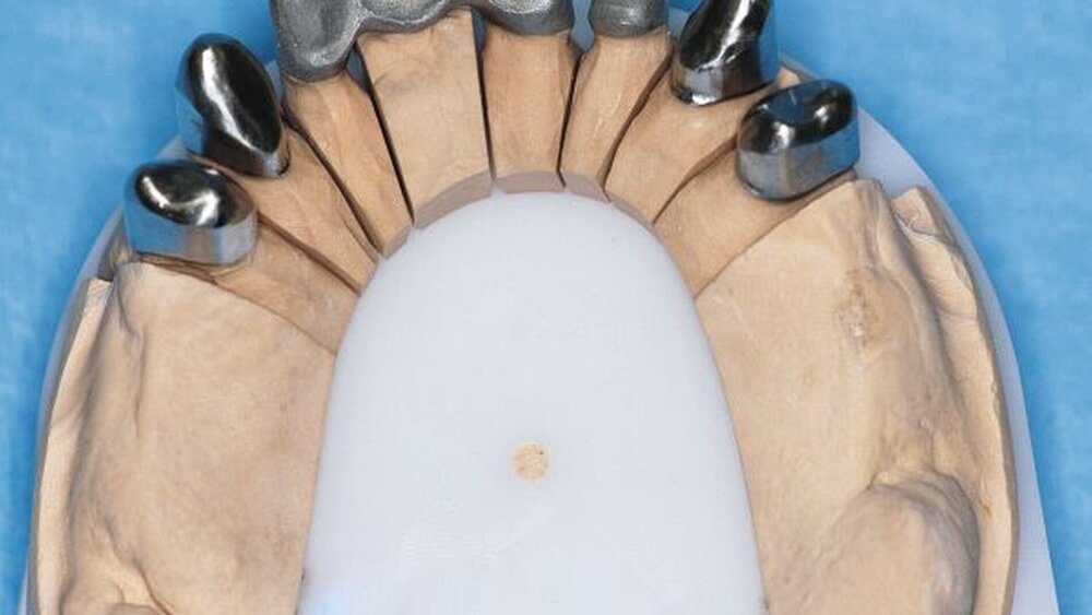 Abbildungen 13a, 13b, 13c: Gerüste (Nichtedelmetalllegierung). |