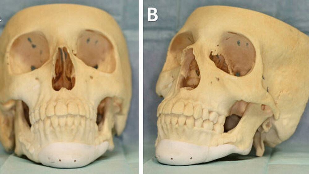 Abbildung 2: Mittels CAD/CAM-Technik präoperativ aus den CT-Daten angefertigtes Schädelmodell mit dem späteren Bioverit®II-Implantat von frontal (A) und von halbsagittal links (B)|