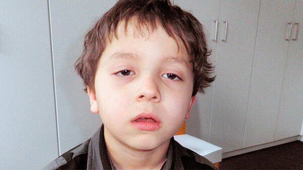Fall 1: Der Befund des neunjährigen Patienten zeigt ein aufgeworfenes, schlaffes Lippenprofil durch Mundatmung. Ebenso auffällig ist eine hypotone Gesichtsmuskulatur sowie ein hypotoner Gesamtkörpertonus. Die Kopfhaltung des Jungen ist retrudiert. Abbildung 1: Der kleine Patient beim Erstbesuch |