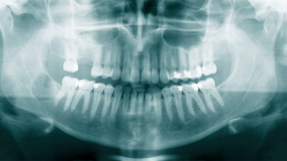 Abbildung 7: Postoperatives Orthopantomogramm |