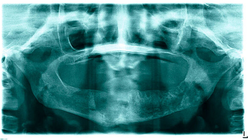 Abbildung 5: Postoperative Situation nach Redekortikation, Resequestrotomie und erneuter modellierender Osteotomie regio 036 im Orthopantomogramm. |