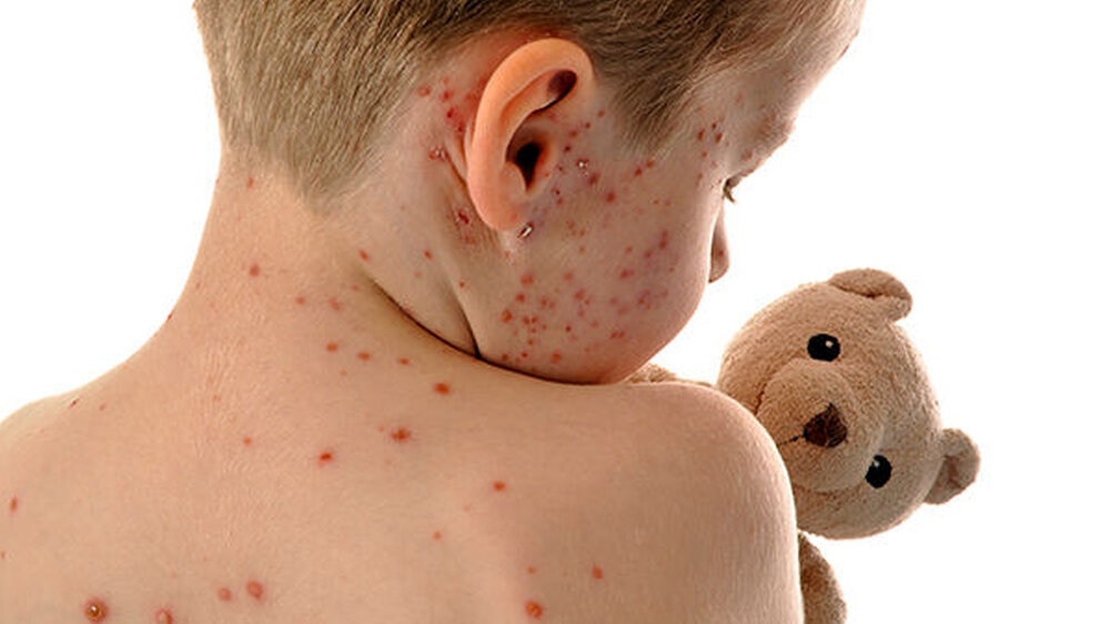 Ärzte und Politiker fordern eine Impfpflicht für Kinder gegen Masern und andere Infektionskrankheiten - wie Windpocken.