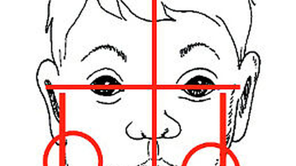 2b: Rheumatypische Befunde für Asymmetrie |