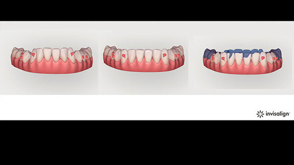 3D-Modell der Zahnbewegung im Unterkiefer und Platzierung der Attachments im Planungstool ClinCheck