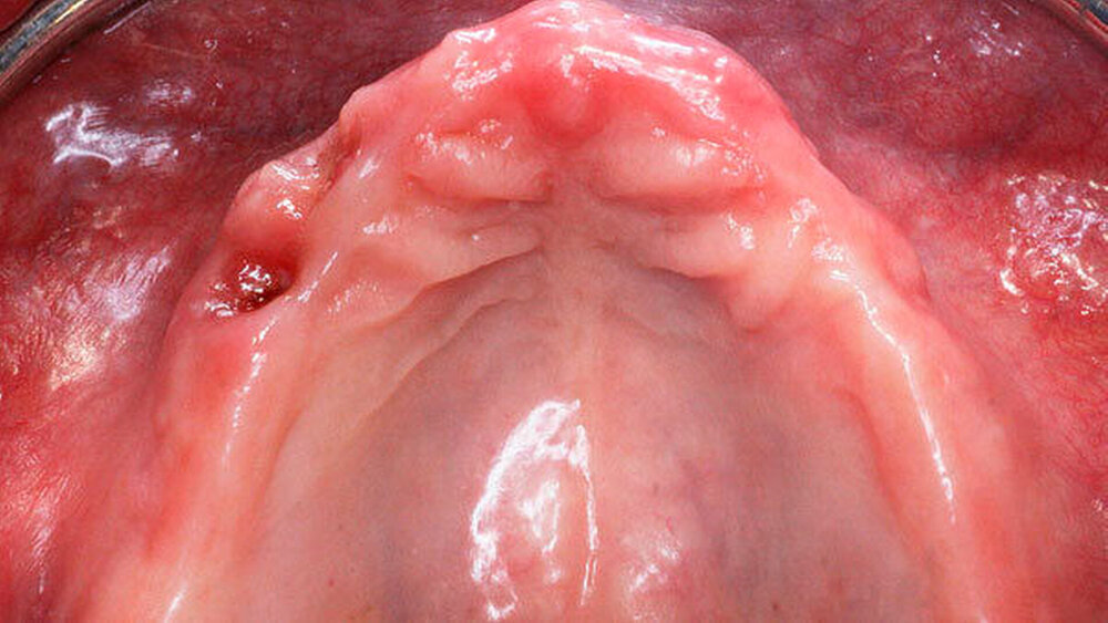 Abbildung 4: All-on-4 Konzept unter Verwendung von Zygoma-Implantaten a) Ausgangssituation |