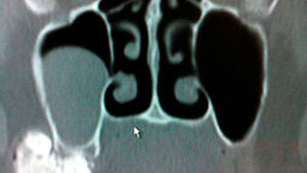 Der röntgenologische „Befund“ nach einem Sturz der Patientin startete eine umfangreiche Diagnostik. Es wäre aber einfacher gegangen.