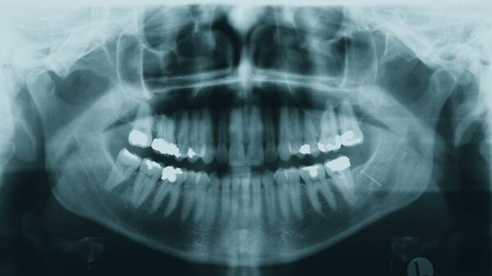 Abbildung 1: präoperatives Orthopantomogramm: Zu erkennen ist eine ovaläre Aufweitung mit Projektion auf den linken Mandibularkanal retromolar.
