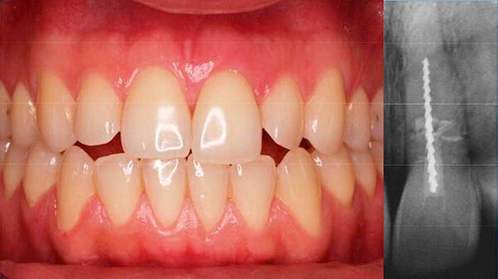 Abbildung 1: Ausgangszustand (links) mit elongierter Krone Regio 21 und initialem Zahnfilm (r.): Deutlich sichtbar ist die endodontische Feile im Kanallumen nebst extrudiertem Befestigungsmaterial.