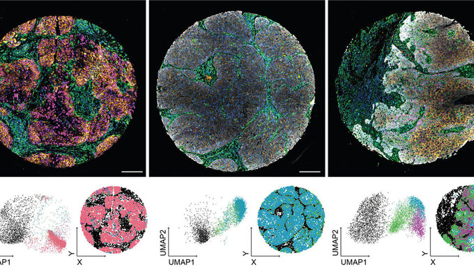 Patientenbiopsien wurden mit fluoreszierenden Antikörpern gefärbt. Die Kombination von morphologischen und Zellstatus-Markern ermöglicht eine multiparametrische Beschreibung jeder Zelle im Gewebe. Patientenbiopsien wurden mit fluoreszierenden Antikörpern gefärbt. Die Kombination von morphologischen und Zellstatus-Markern ermöglicht eine multiparametrische Beschreibung jeder Zelle im Gewebe.